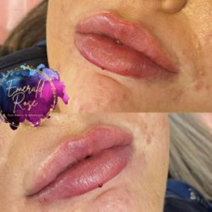 Lip Filler / Advanced Technique.