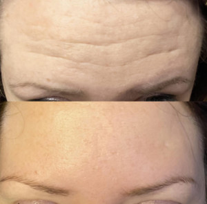 3 Botox Areas