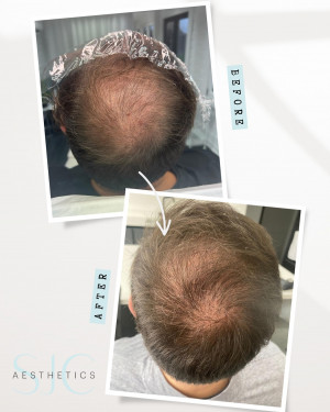 PRP HAIR RESTORATION