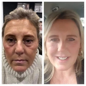 Anti Wrinkle Injections