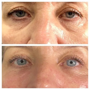 Anti Wrinkle Injections