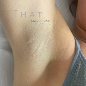 Laser Hair Removal