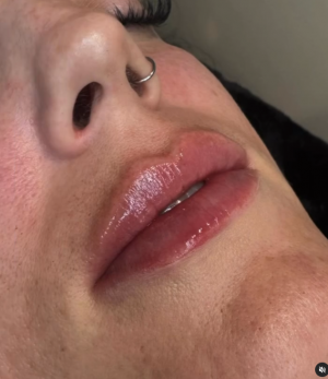 Lip Filler