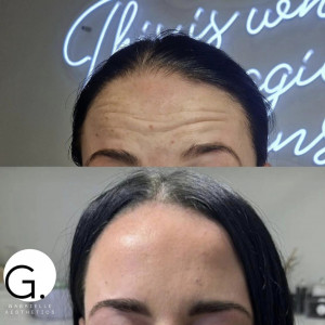 Forehead Botox