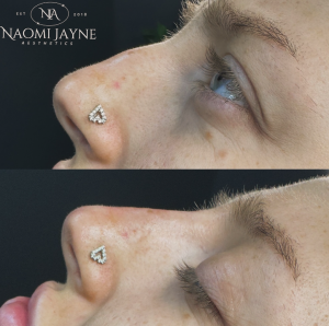 None Surgical Rhinoplasty