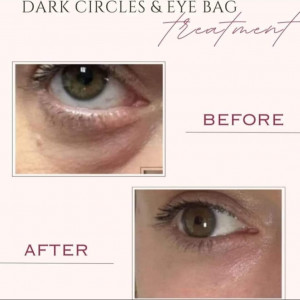 Skin Booster - Dark Eye Circles