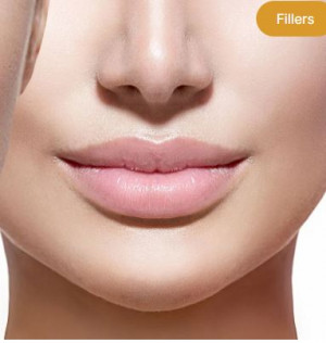 Lip Filler